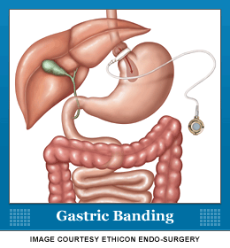 Gastric Banding