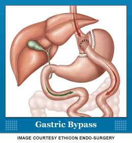 gastric bypass