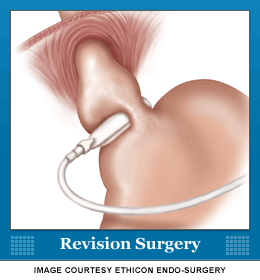 Revision Bariatric Surgery