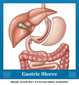Gastric sleeve / Sleeve Gastrectomy