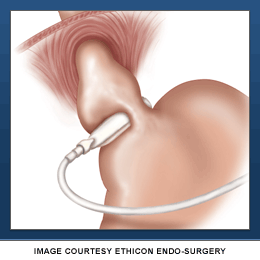 Revision Bariatric Surgery